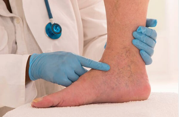 Varicose veins – causes and treatment – everything you need to know